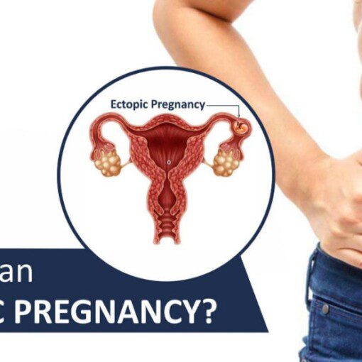Ectopic Pregnancy
