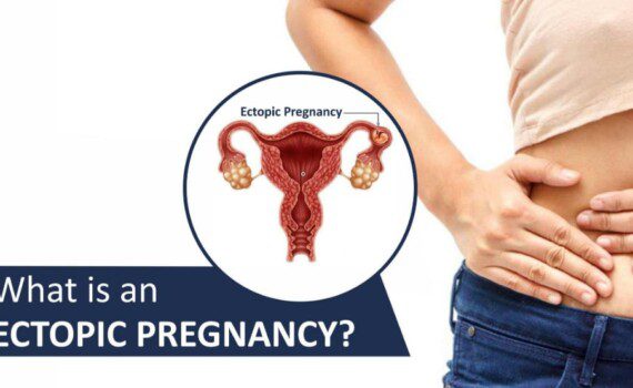 Ectopic Pregnancy