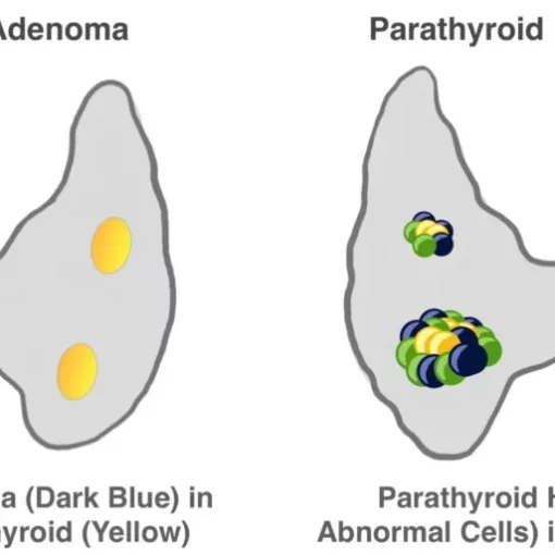 Diagnosis of Parathyroid Adenoma